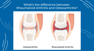 difference between rheumatoid arthritis and osteoarthritis